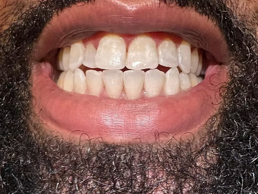 Everyday brightening refresh — after cosmetic teeth brightening