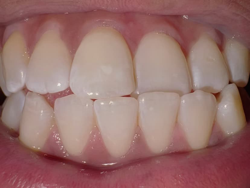 Event-ready brightening — after cosmetic teeth brightening