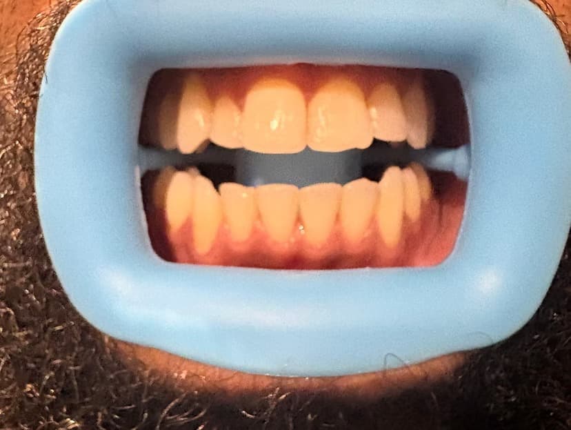 Everyday brightening refresh — before cosmetic teeth brightening