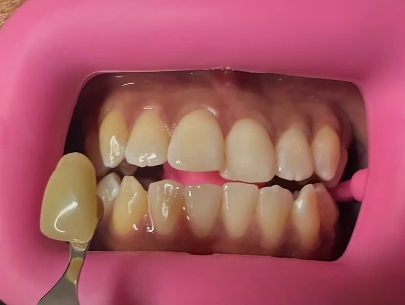 Event-ready brightening — before cosmetic teeth brightening